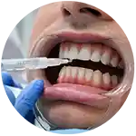 Tratamiento de blanqueamiento dental