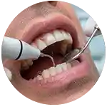 Tratamiento limpieza dental