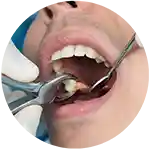 Extracción dental