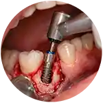 Implantes dentales