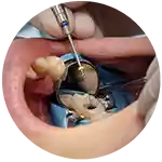 tratamiento dental de endodoncia